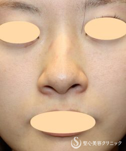 【20代女性・鼻の穴を見えにくく、少し鼻翼挙上】 鼻翼縮小術（外側法）（術後1ヶ月） Before 
