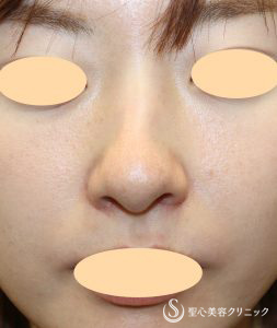 【20代女性・鼻の穴を見えにくく、少し鼻翼挙上】 鼻翼縮小術（外側法）（術後1ヶ月） After 