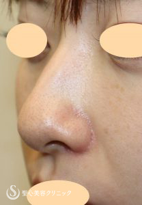 【20代女性・鼻の穴を見えにくく、少し鼻翼挙上】 鼻翼縮小術（外側法）（術後1ヶ月） After 