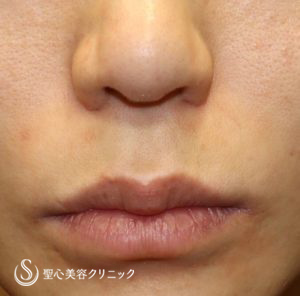 【30代女性・ 人中を短く、小鼻を高く】鼻下短縮術（リップリフト、人中短縮）（ 術後1ヶ月） Before 