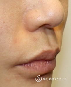 【30代女性・ 人中を短く、小鼻を高く】鼻下短縮術（リップリフト、人中短縮）（ 術後1ヶ月） Before 