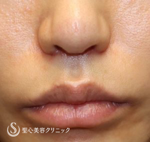 【30代女性・ 人中を短く、小鼻を高く】鼻下短縮術（リップリフト、人中短縮）（ 術後1ヶ月） After 