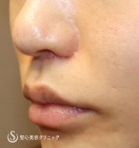 【30代女性・ 人中を短く、小鼻を高く】鼻下短縮術（リップリフト、人中短縮）（ 術後1ヶ月） After 