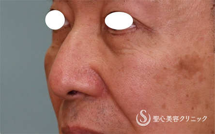 【60代男性・目の下のたるみ改善】下眼瞼切開（1ヵ月後） After 