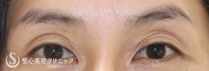 【50代女性・目の上の窪みを改善してお若く】プレミアムPRP皮膚再生療法（施術後1年） Before 