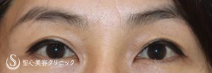【50代女性・目の上の窪みを改善してお若く】プレミアムPRP皮膚再生療法（施術後1年） After 