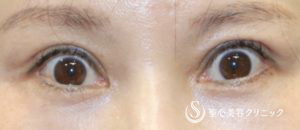 【40代女性・他院修正（眼瞼下垂手術後の過矯正を修正）】グラマラスライン切開術（術後8ヶ月） Before 