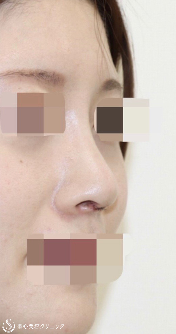 【30代女性・他院修正(お鼻をさらに高く・ちょっとアップノーズに)】鼻中隔延長＋鼻尖形成（術後1週間） After 