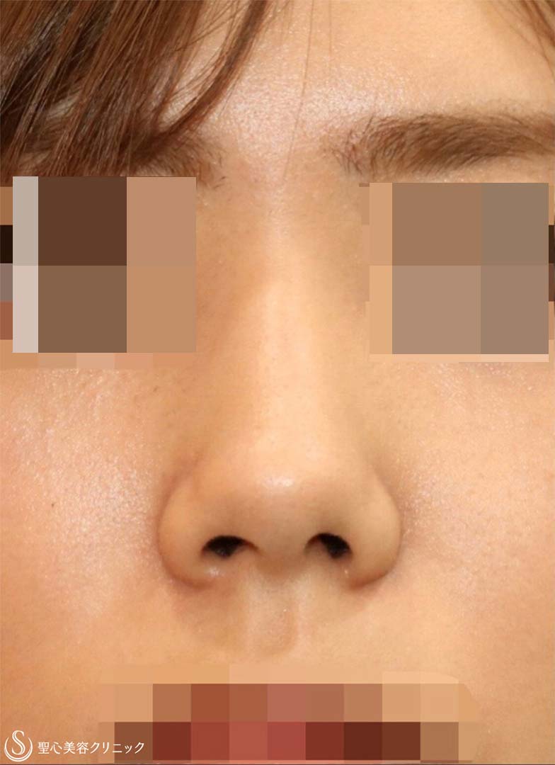 【20代女性・美鼻整形】鼻尖縮小＋鼻尖形成(耳介軟骨移植)＋プロテーゼ（術後6ヶ月） Before 