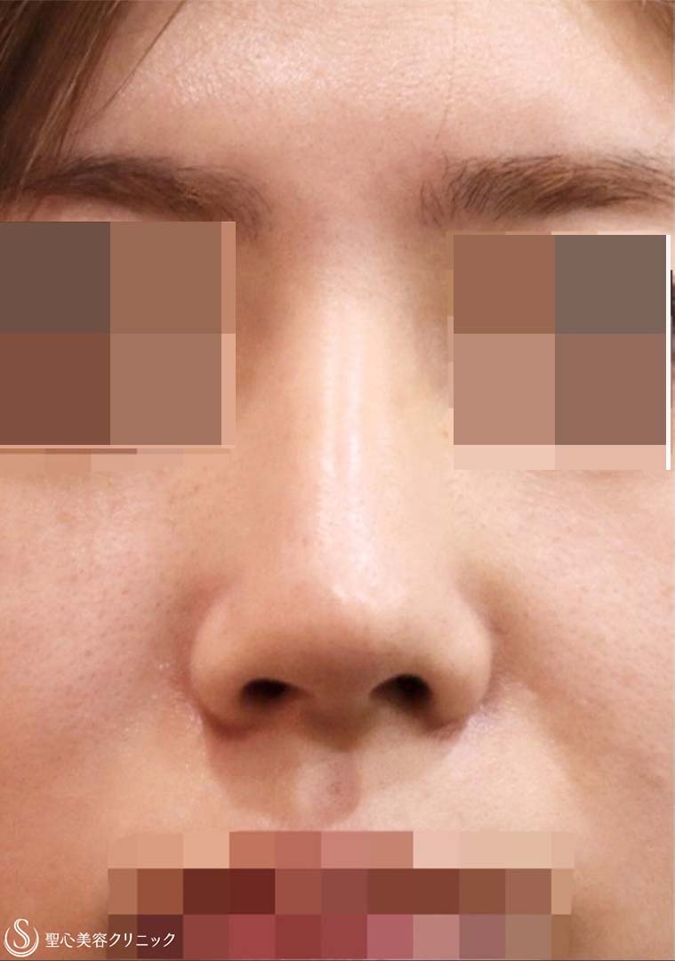 【20代女性・美鼻整形】鼻尖縮小＋鼻尖形成(耳介軟骨移植)＋プロテーゼ（術後6ヶ月） After 