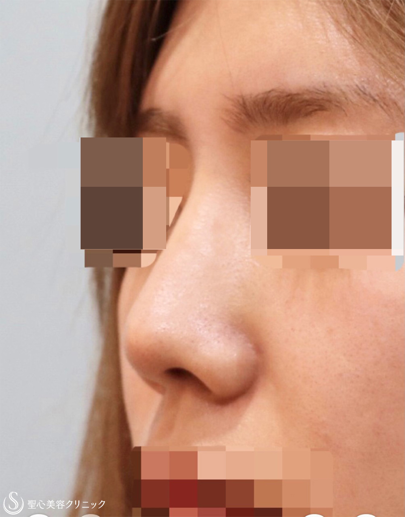 【20代女性・美鼻整形】鼻尖縮小＋鼻尖形成(耳介軟骨移植)＋プロテーゼ（術後6ヶ月） After 