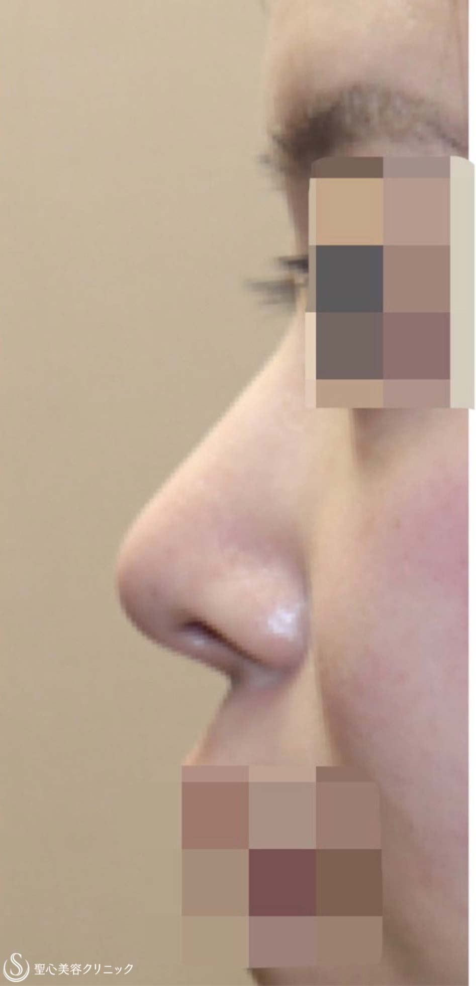 【20代女性・鼻先をナチュラルに高く】鼻尖縮小術＋鼻尖形成術（耳介軟骨移植）（術後3ヶ月） After 