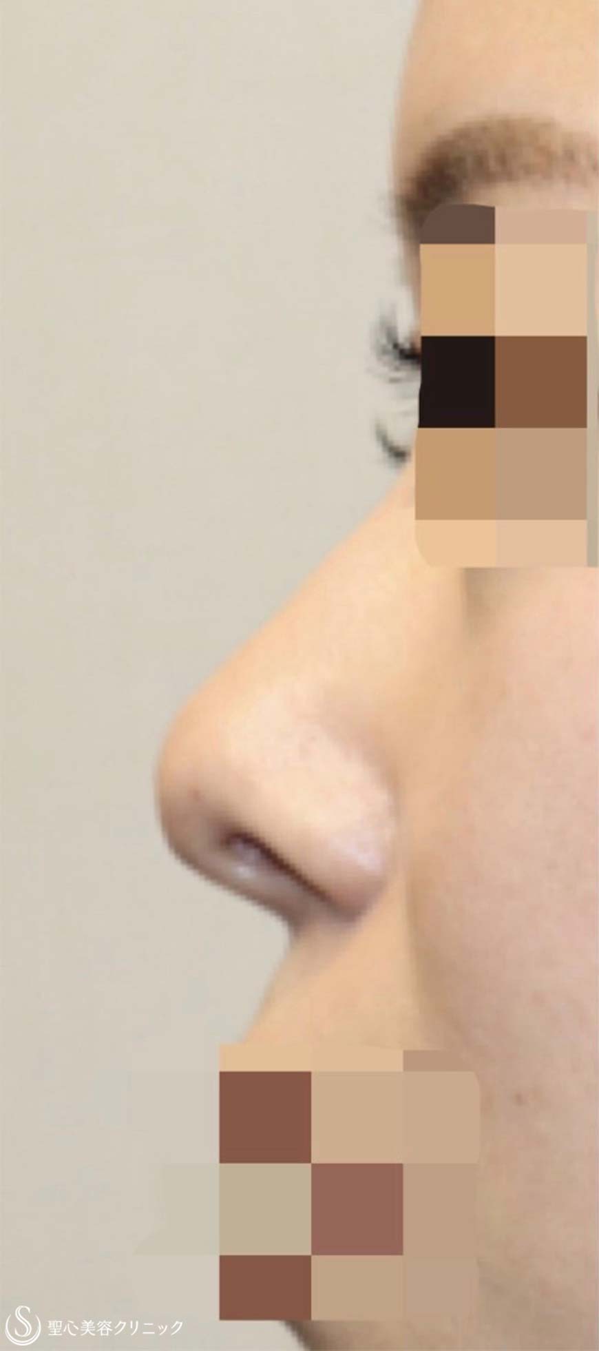 【20代女性・鼻先をナチュラルに高く】鼻尖縮小術＋鼻尖形成術（耳介軟骨移植）（術後3ヶ月） Before 