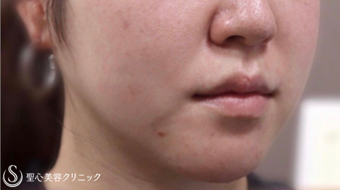 【20代女性・切らずに小顔】FatX3回コース（2回施術後） Before 