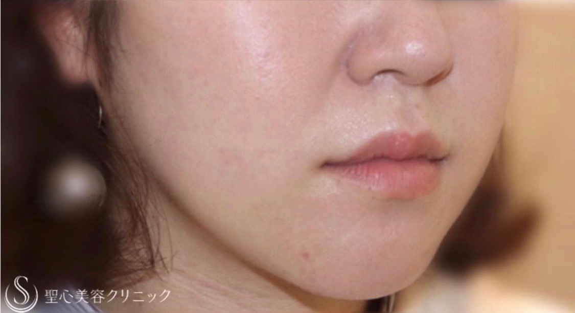 【20代女性・切らずに小顔】FatX3回コース（2回施術後） After 