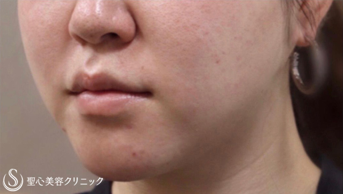 【20代女性・切らずに小顔】FatX3回コース（2回施術後） Before 