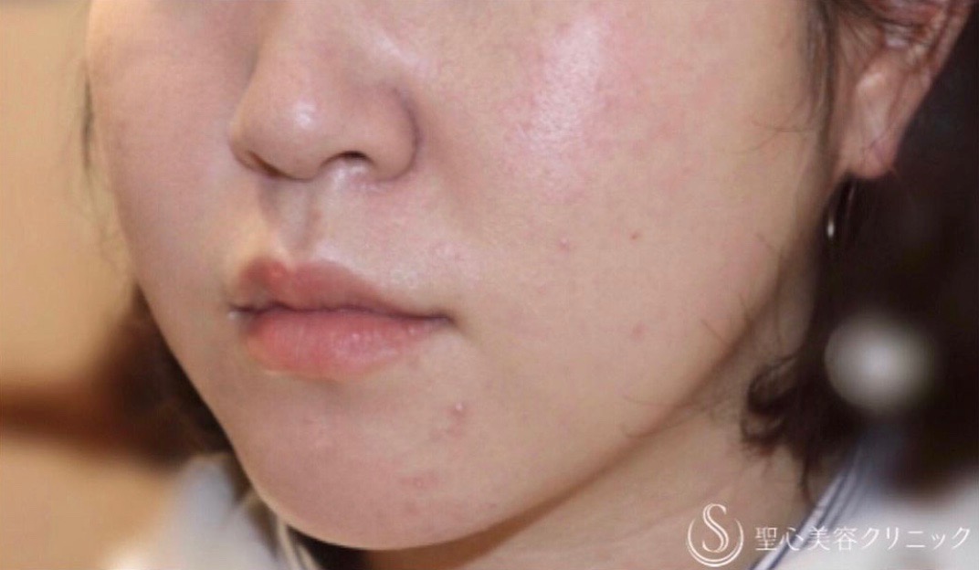 【20代女性・切らずに小顔】FatX3回コース（2回施術後） After 