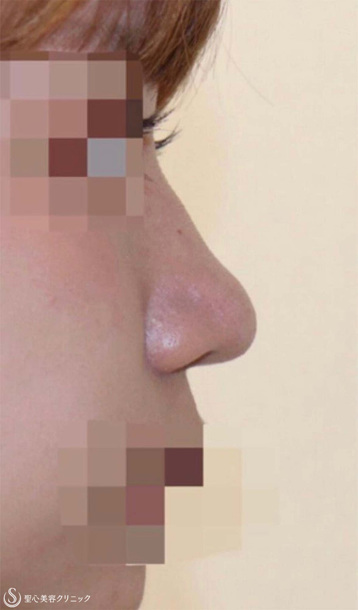 【20代女性・鼻背をスッと高く】プロテーゼ隆鼻術（術後2ヶ月） Before 