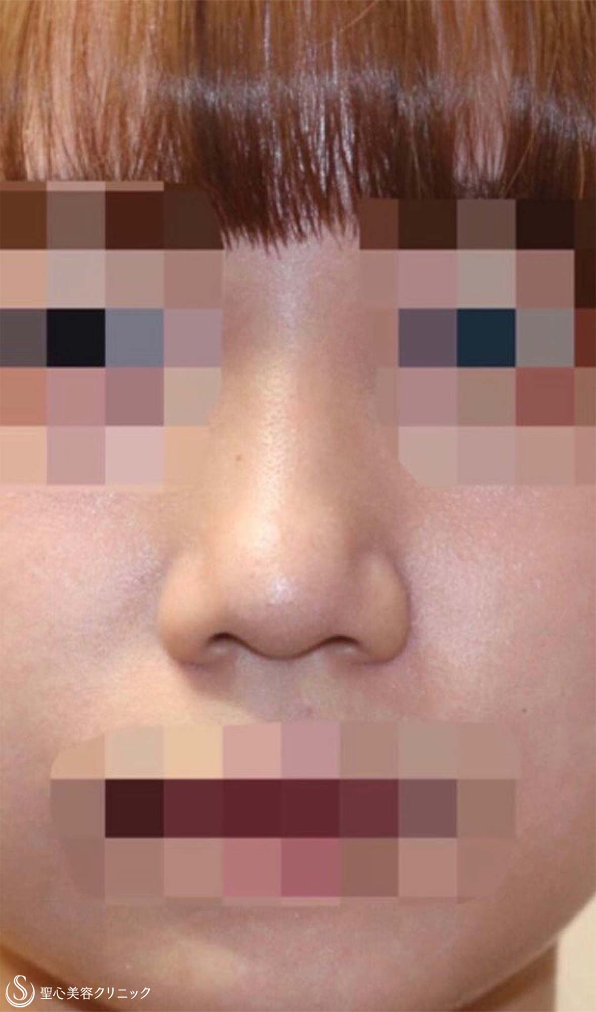 【20代女性・鼻背をスッと高く】プロテーゼ隆鼻術（術後2ヶ月） Before 
