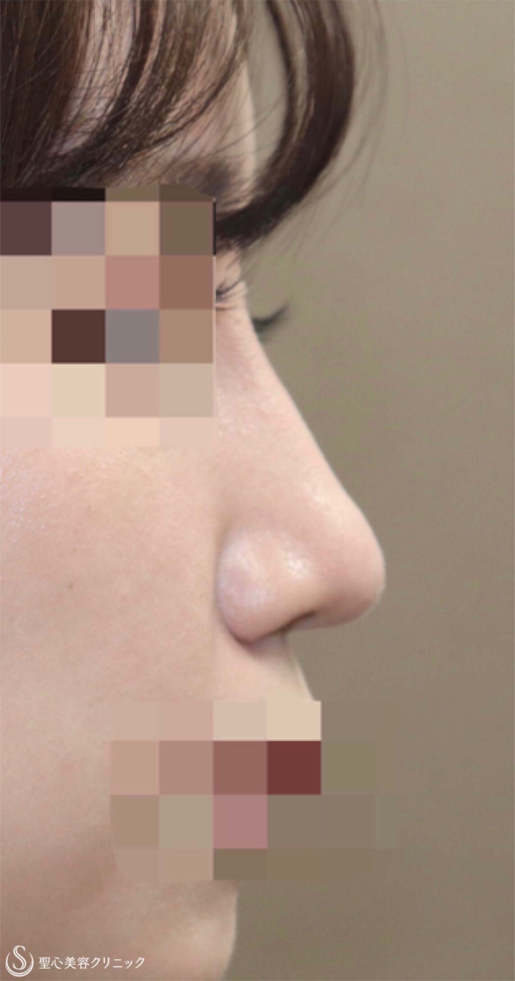 【20代女性・鼻背をスッと高く】プロテーゼ隆鼻術（術後2ヶ月） After 