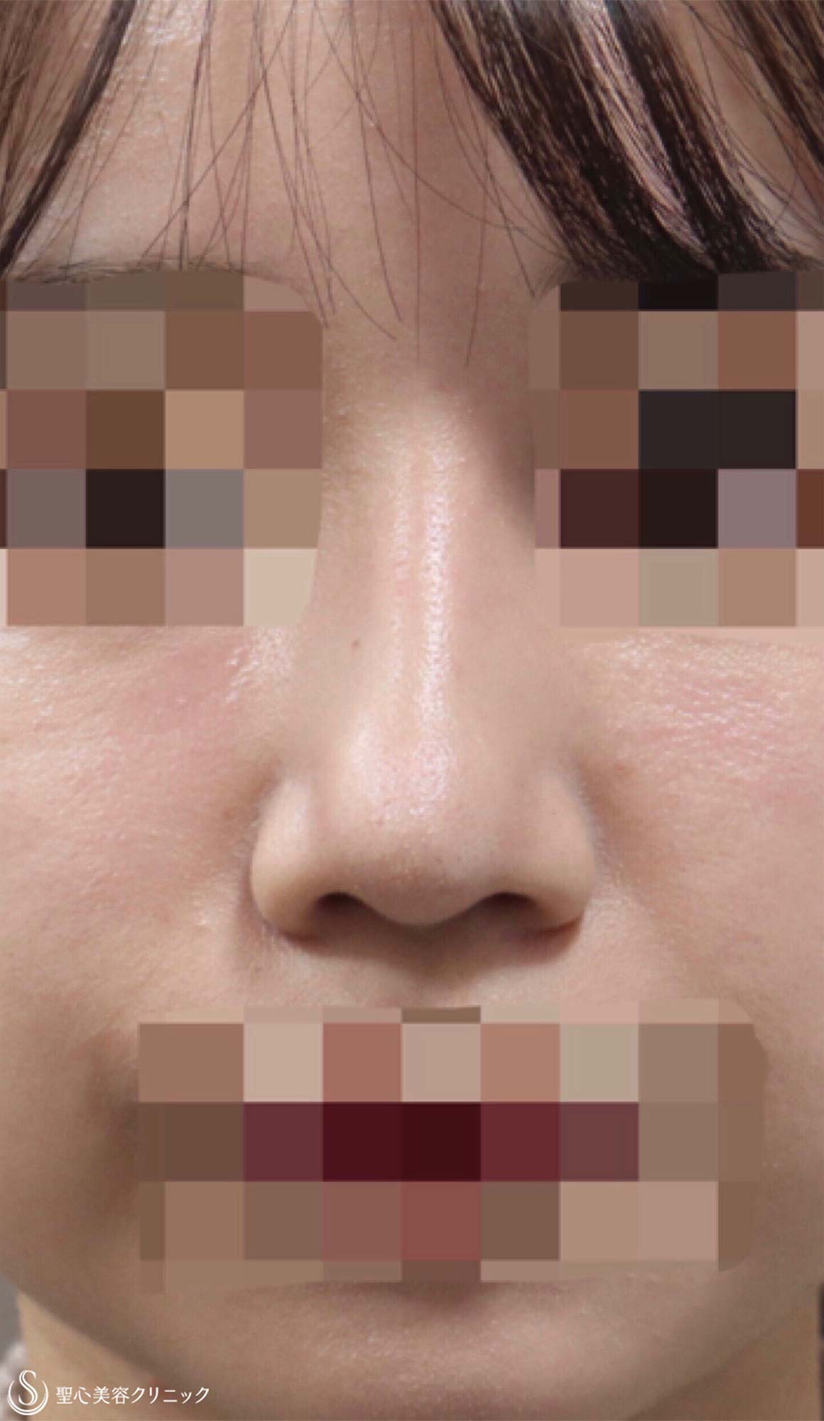 【20代女性・鼻背をスッと高く】プロテーゼ隆鼻術（術後2ヶ月） After 