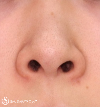 【30代女性・鼻の穴を目立たなく】鼻孔縁下降術（1ヵ月後） Before 