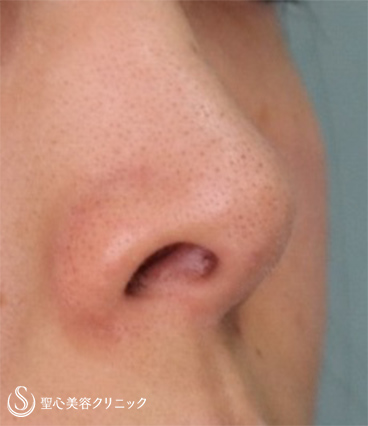 【30代女性・鼻の穴を目立たなく】鼻孔縁下降術（1ヵ月後） Before 