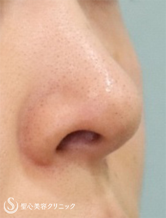 【30代女性・鼻の穴を目立たなく】鼻孔縁下降術（1ヵ月後） After 
