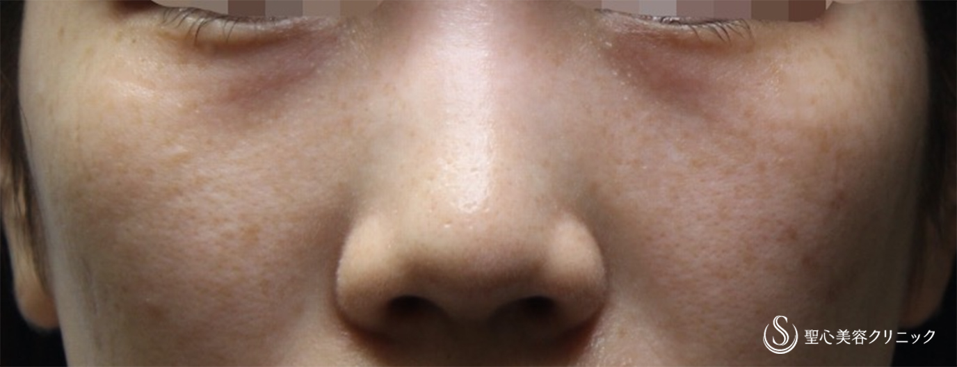 【20代女性・切らない目の下のクマ治療】プレミアムPRP皮膚再生療法（2ヶ月半後） Before 