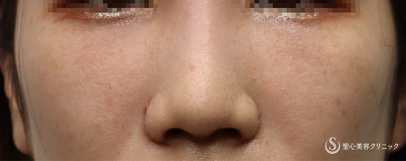 【20代女性・切らない目の下のクマ治療】プレミアムPRP皮膚再生療法（2ヶ月半後） After 