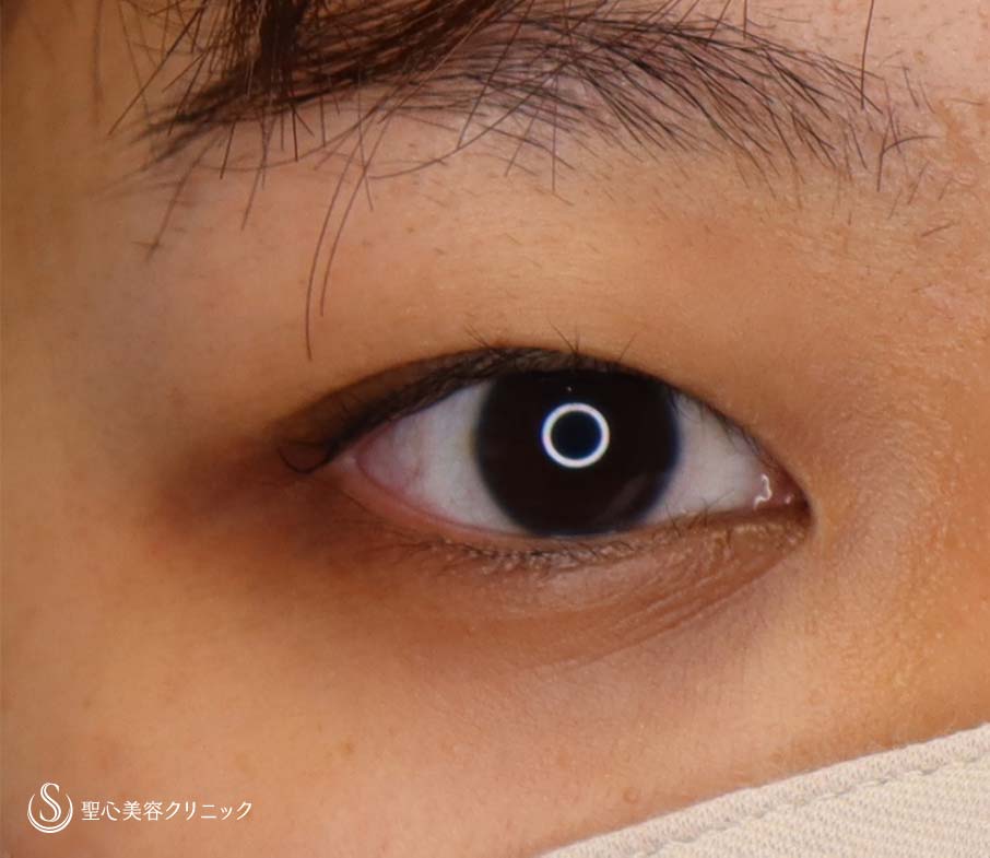 【20代女性・ナチュラルな二重に！！】マイクロメソッド＋α（1ヶ月後） Before 