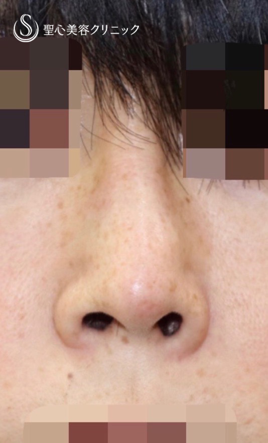 【40代男性・小鼻の左右差を調整】小鼻縮小術（術後4ヶ月） Before 