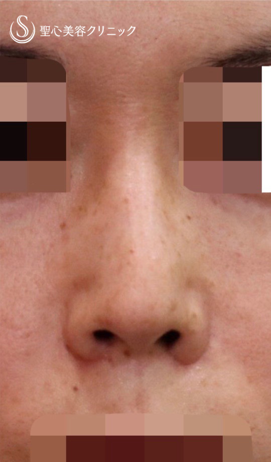 【40代男性・小鼻の左右差を調整】小鼻縮小術（術後4ヶ月） After 
