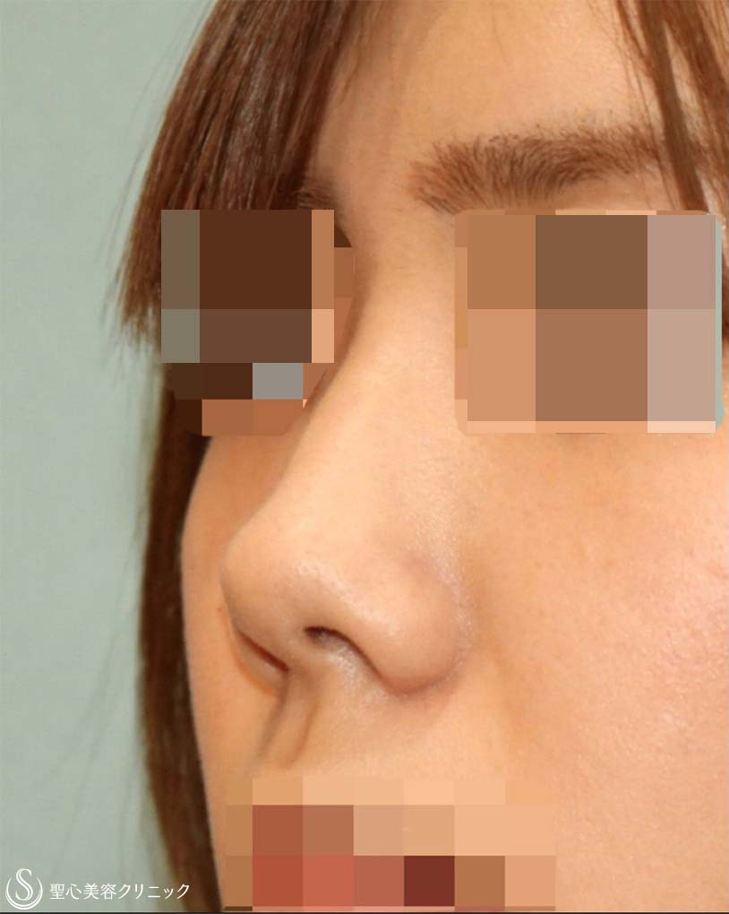 【20代女性・美鼻整形】鼻尖縮小＋鼻尖形成(耳介軟骨移植)＋プロテーゼ（術後6ヶ月） Before 