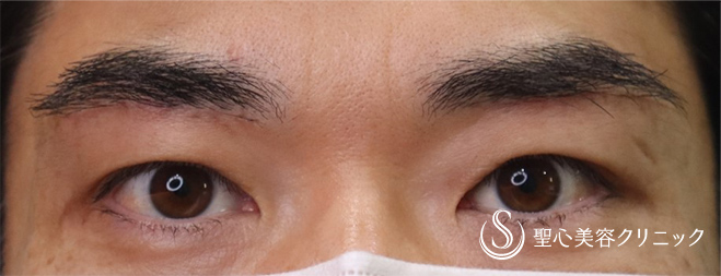 40代男性 目の上のたるみ 眉下リフト 術後1ヶ月 症例写真 美容整形 美容外科なら聖心美容クリニック 40代男性 目の上のたるみ 眉下リフト 術後1ヶ月 症例写真 美容整形 美容外科なら聖心美容クリニック