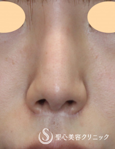 【20代女性・小鼻を小さく、かつ挙上】鼻翼縮小術（術後1.5ヶ月） Before 