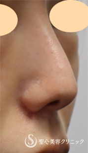 【20代女性・小鼻を小さく、かつ挙上】鼻翼縮小術（術後1.5ヶ月） After 