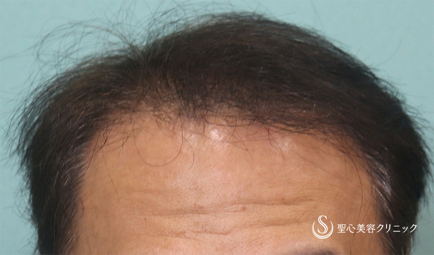 【60代男性・毛髪治療】プレミアムグロースファクター療法（4ヶ月後） Before 