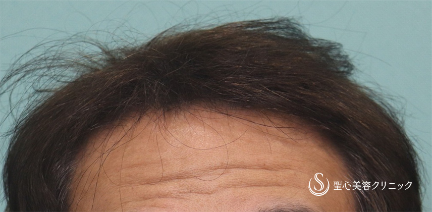 【60代男性・毛髪治療】プレミアムグロースファクター療法（4ヶ月後） After 