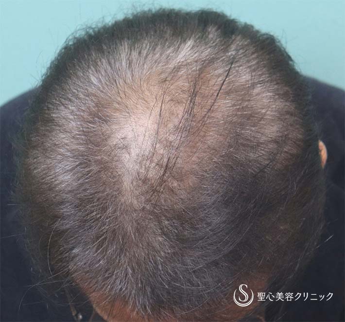 【60代男性・毛髪治療】プレミアムグロースファクター療法（4ヶ月後） After 