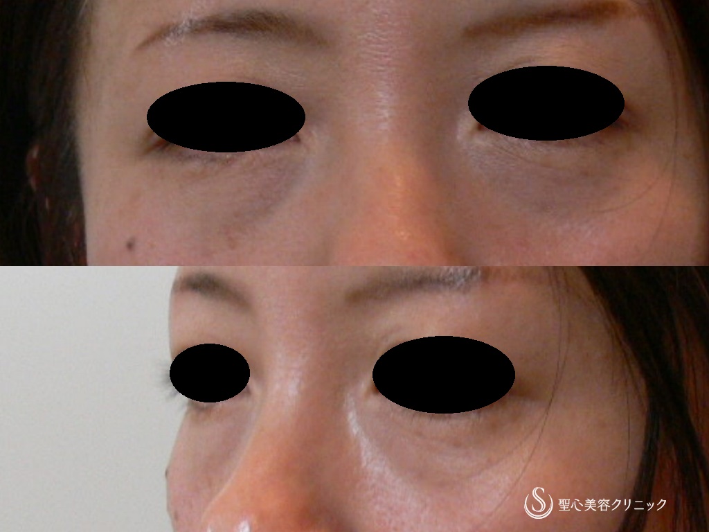 【50代女性・目の下のクマ、たるみ】目の下のプレミアムPRP皮膚再生療法（11年後） Before 