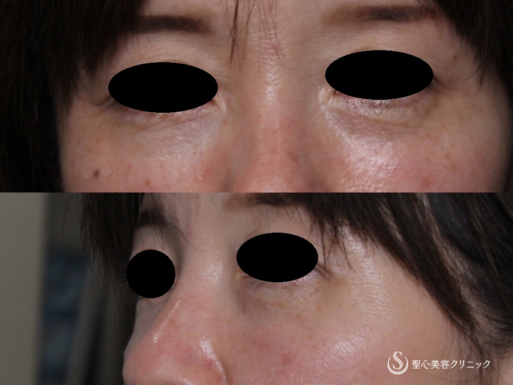 【50代女性・目の下のクマ、たるみ】目の下のプレミアムPRP皮膚再生療法（11年後） After 