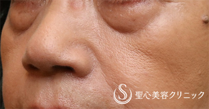 【70代女性・目の下のたるみクマ】プレミアムPRP皮膚再生療法（7ヵ月後） Before 