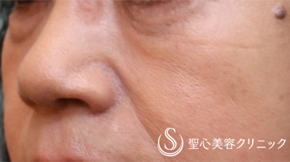 【70代女性・目の下のたるみクマ】プレミアムPRP皮膚再生療法（7ヵ月後） After 