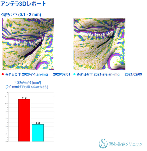 【70代女性・目の下のたるみクマ】プレミアムPRP皮膚再生療法（7ヵ月後） After 