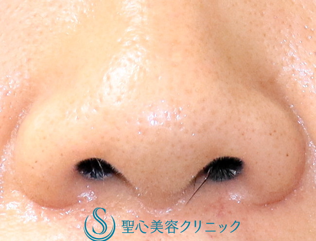 【50代女性・鼻の穴を正面から見て縦方向に見えにくくしたい】鼻孔縁下降術（2カ月後） Before 