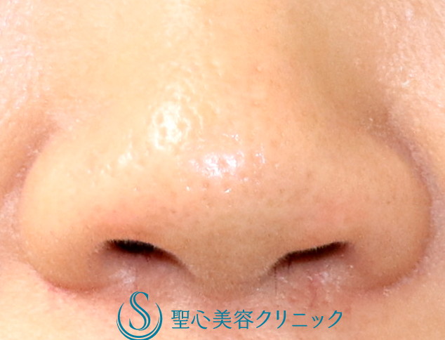 【50代女性・鼻の穴を正面から見て縦方向に見えにくくしたい】鼻孔縁下降術（2カ月後） After 