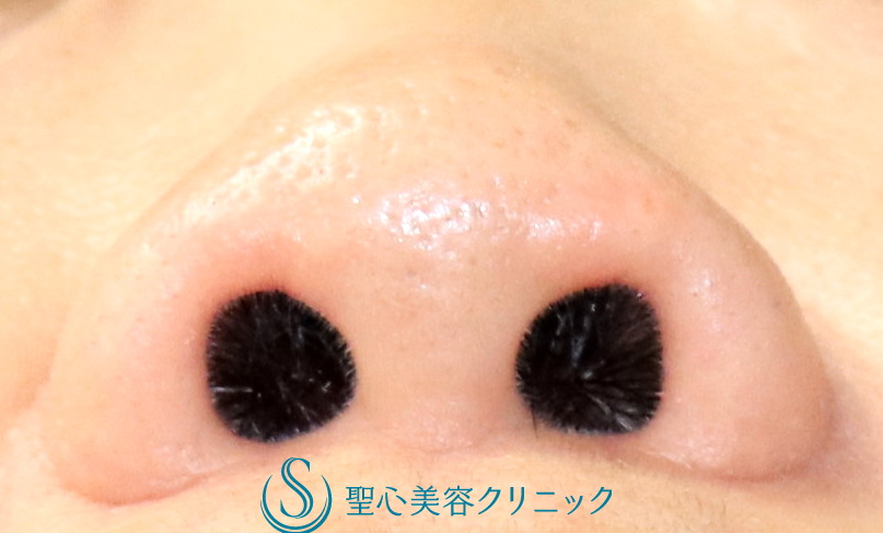 【50代女性・鼻の穴を正面から見て縦方向に見えにくくしたい】鼻孔縁下降術（2カ月後） After 