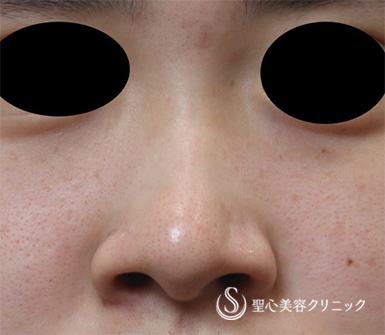 【20代女性・鼻のプロテーゼ】プロテーゼによる隆鼻術（術後3ヶ月） Before 
