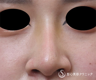 【20代女性・鼻のプロテーゼ】プロテーゼによる隆鼻術（術後3ヶ月） After 